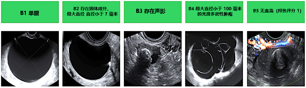 Benign Non-Cancerous Ovarian Cysts