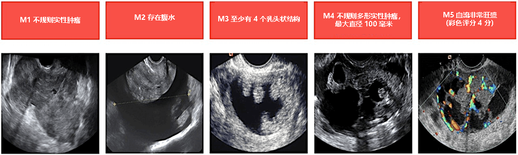 Malignant Cancerous Ovarian Cysts