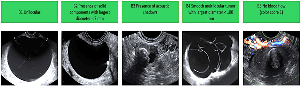 Benign Non-Cancerous Ovarian Cysts