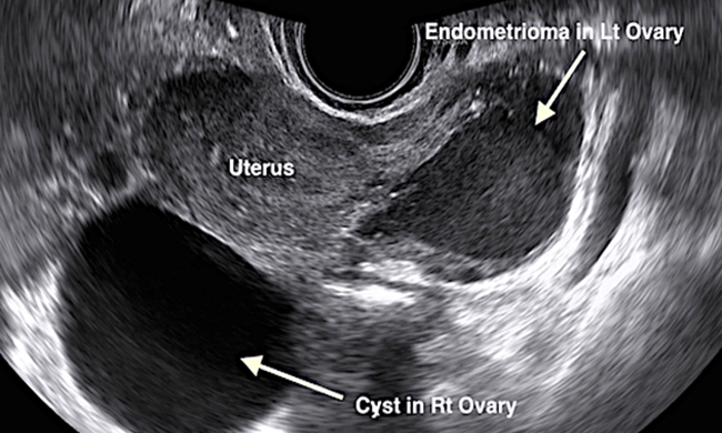 Ovarian Cyst Symptoms