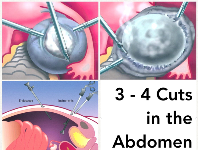 Laparoscopic Cystectomy