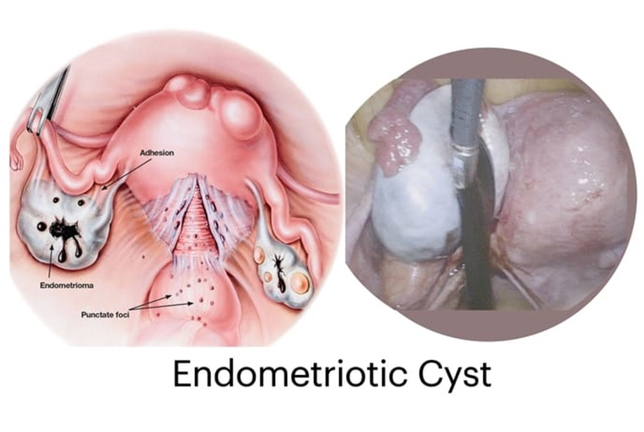 Blood Cyst Endometriosis