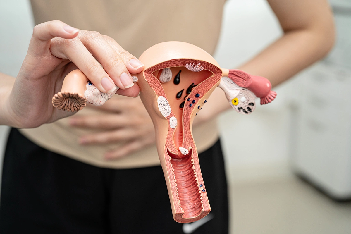 How Are Recurrent Ovarian Cysts Managed? Treatment Options Explained