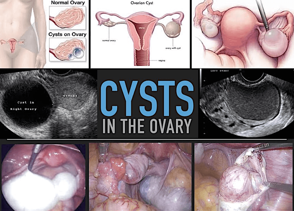 Cysts in the Ovary