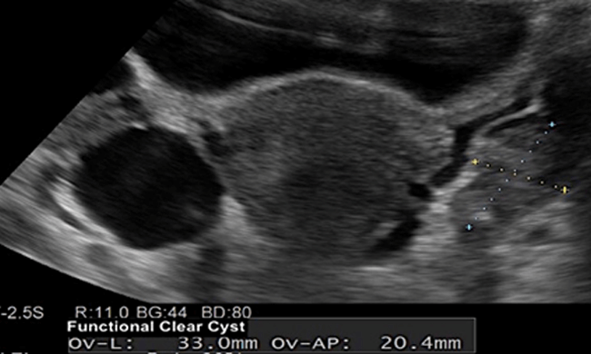 Ovarian Cyst Symptoms Singapore