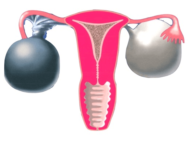 Ovarian Cyst Symptoms