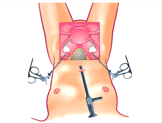 Ovarian Cyst Treatment - Laparoscopic Cystectomy