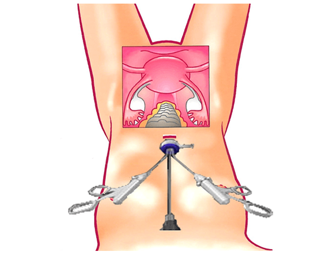 Ovarian Cyst Treatment Procedure