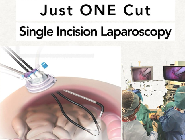 Single Incision Laparoscopy