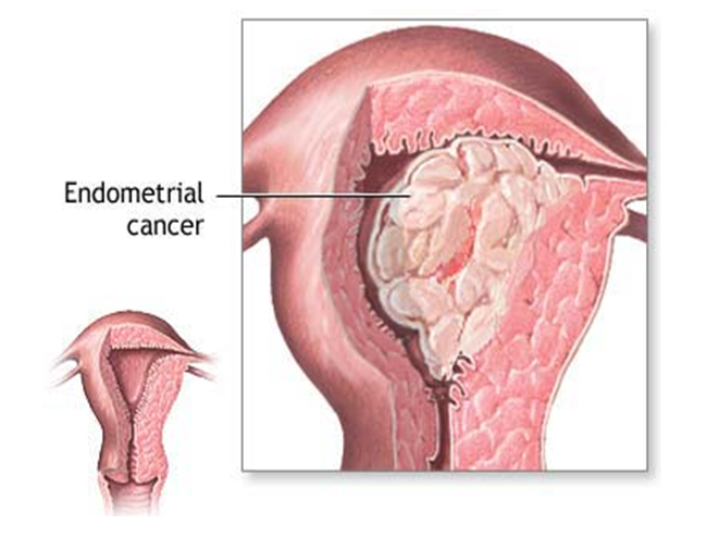 Endometrial Hyperplasia and/or Cancer