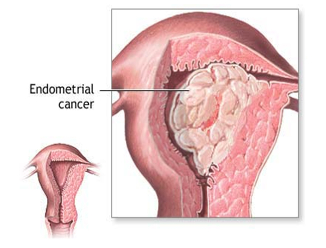 PCOS Treatment