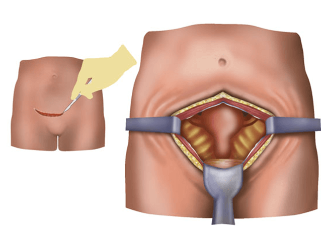 Laparotomy