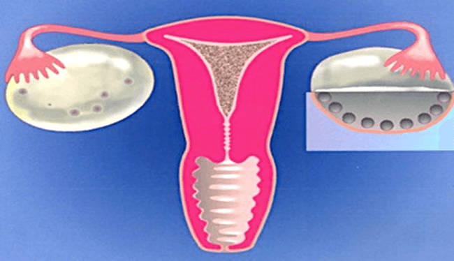 Polycystic Ovary (PCOS)