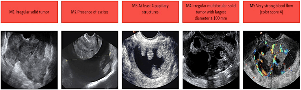 Malignant Cancerous Ovarian Cysts